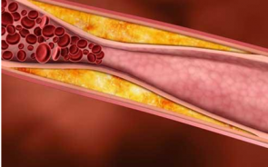 The Terrifying Truth About High Cholesterol