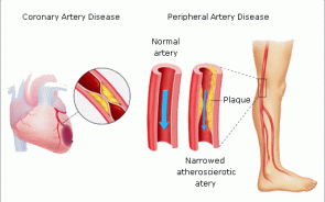 Peripheral Arterial Diseases