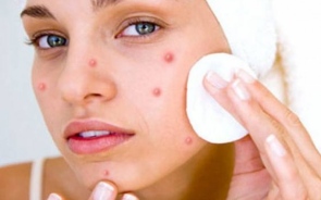 Treating Facial Infections With The Popular Antifungal Creams and Solutions