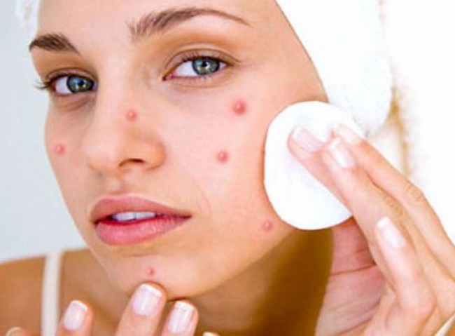 Treating Facial Infections With The Popular Antifungal Creams and Solutions
